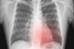 Mengungkap Ketangguhan di Balik Panggung, Kisah Idol Kpop Melawan Pneumothorax